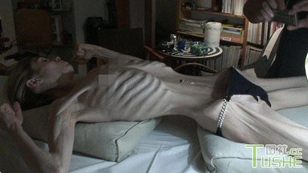 厌食症女孩的凄惨生活