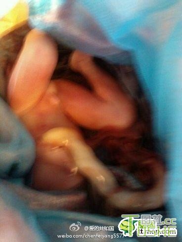 女子失恋打掉胎儿 微博发死胎照